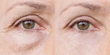 Say Goodbye to Puffy Eyes, Dark Circles, and Crow’s Feet