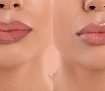 Get Rid of Dark Lips: Causes, Lifestyle Tips, and Natural Solutions